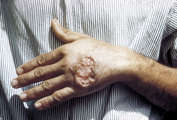 leishmaniasis