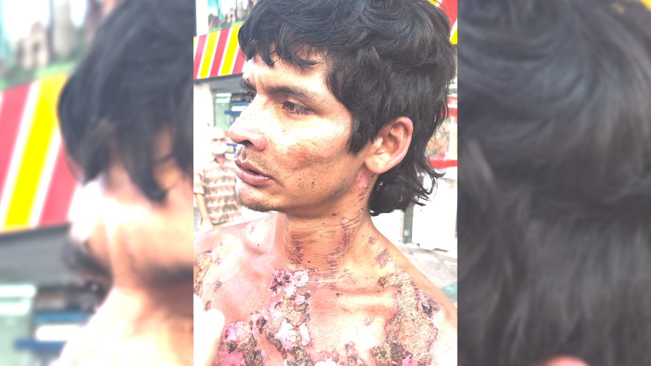 “A mí me mataron a mi mamá, nadie sabe lo de nadie”: habló habitante de calle que se prendió fuego en Ibagué 1