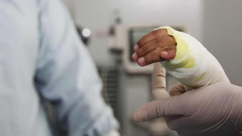 Un menor de edad eleva a 11 los casos de quemados con pólvora en el Tolima 1