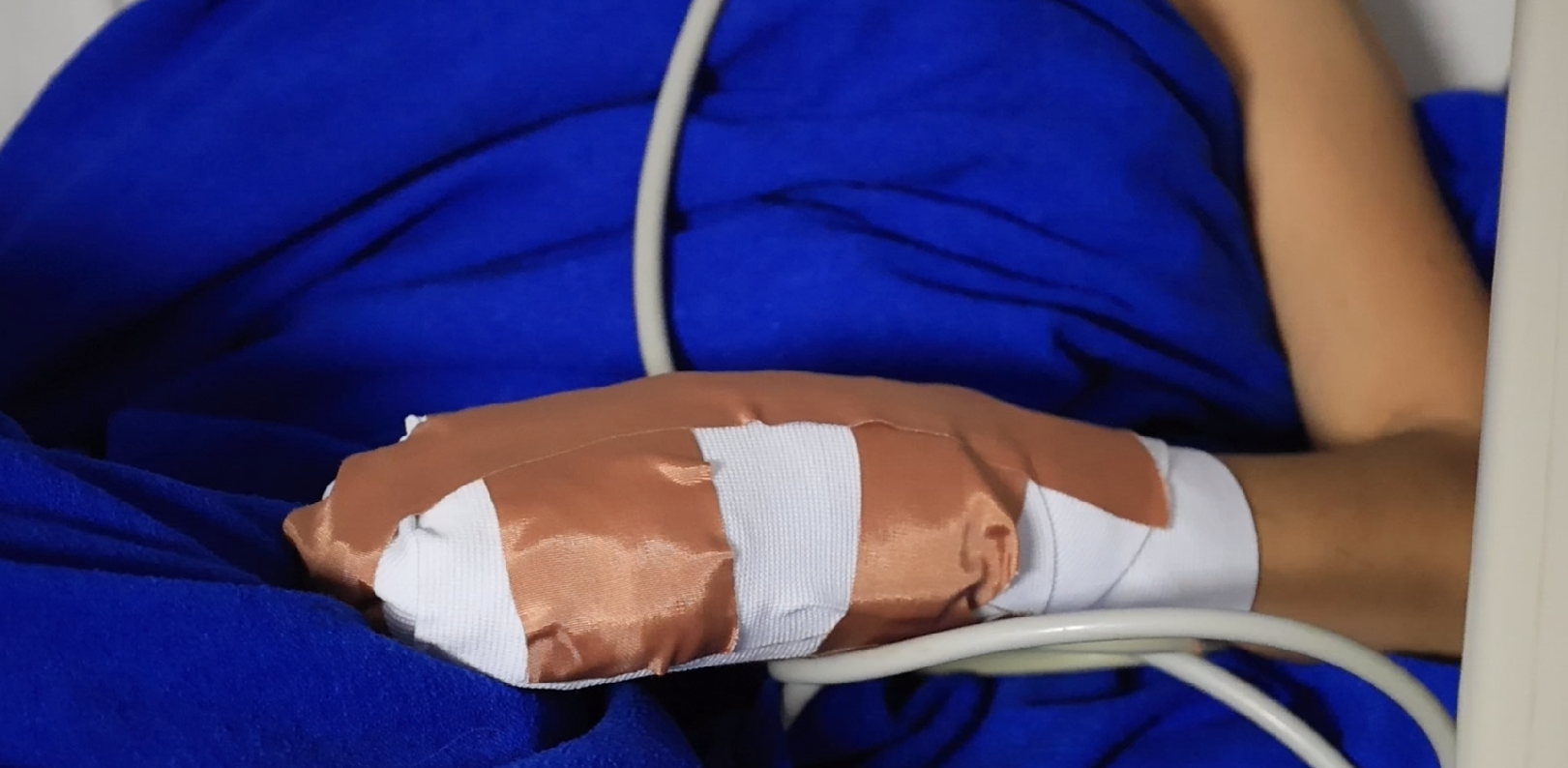 Así se lesionó con pólvora la niña de 11 años en Venadillo: un volador cayó en su casa 1
