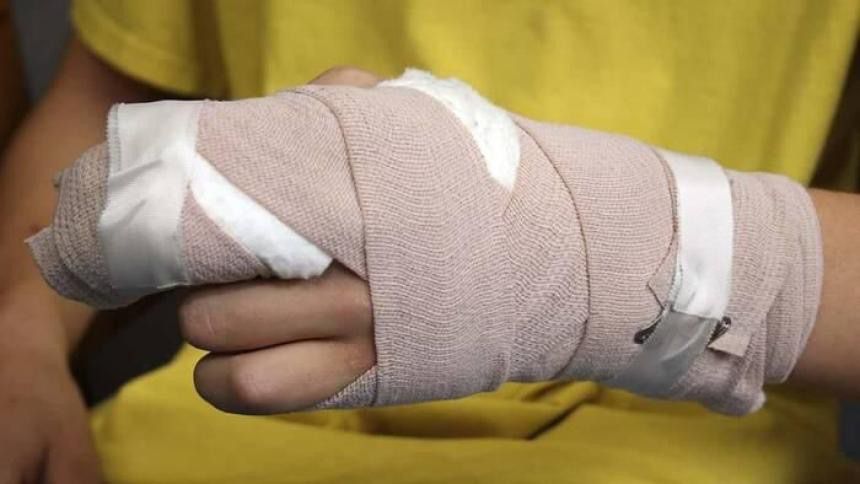 Tolima sumó 4 nuevos casos de personas quemadas con pólvora en la Noche de Velitas 3