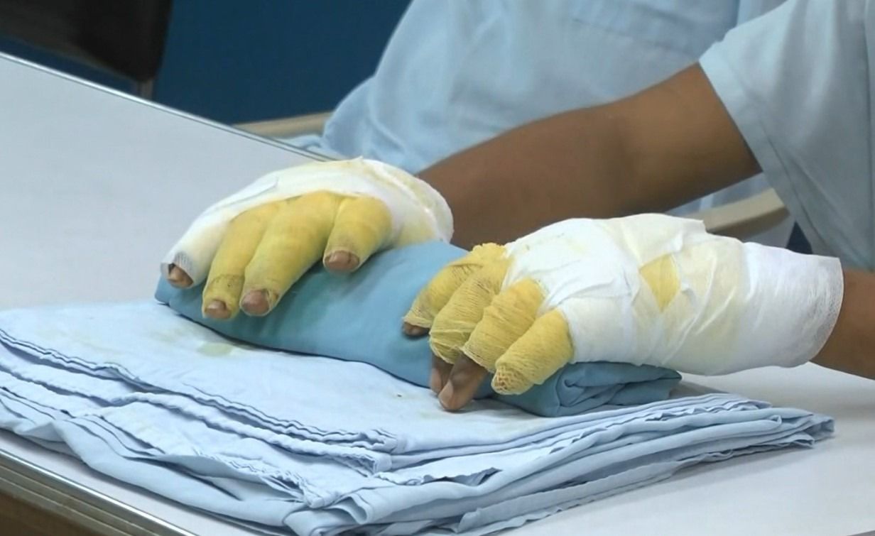 Pólvora sigue dejando víctimas: van 15 quemados en Ibagué 1