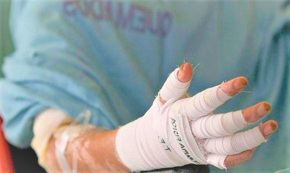 1.295 lesionados por la pólvora en Colombia: Tolima llega a 51 casos 1